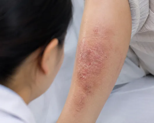 Clinician assessing irritated skin on an arm